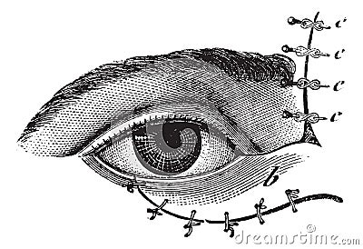 Fig. 178. Blepharoplasty by the method of Blasius, vintage engraving Vector Illustration