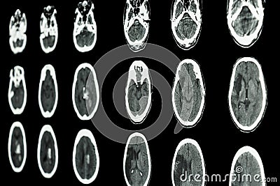 film CT scan of brain show ischemic stroke and hemorrhagic stroke Stock Photo