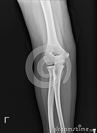 Film elbow AP a male 25 year old fracture. Stock Photo