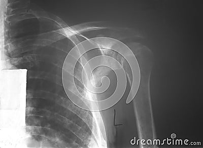 Film left shoulder of a 52 years old man with multiple myeloma (MM), demonstrated punch out bone lesions of humerus and scapular Stock Photo