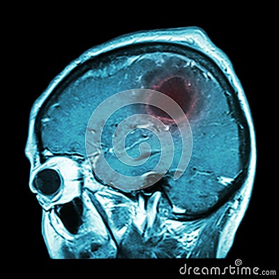 Film MRI of brain with brain tumor ( Sagittal plane , side view , lateral view ) ( Medical , Health care , Science Background ) Stock Photo