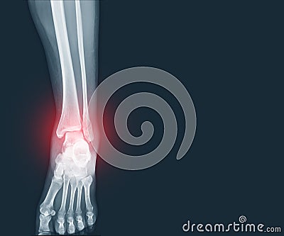 Film x-ray Ankle and Foot fracture distal fibula bone with soft tissues swelling on red mark.Medical healthcare concept Stock Photo