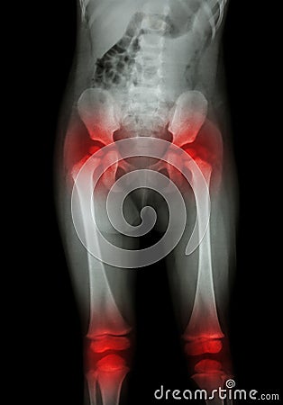 Film x-ray body of child (abdomen,buttock,thigh,knee) and arthritis at both hip , both knee (Gout,Rheumatoid) Stock Photo