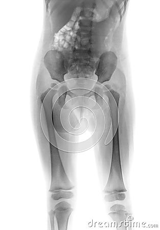 Film x-ray body of child & x28; Lower half of body & x29; Stock Photo