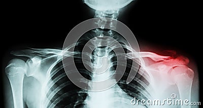 Film x-ray both clavicle AP ( front view ) : show fracture distal left clavicle Stock Photo