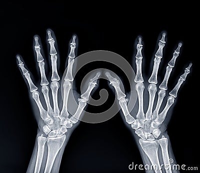 Film x-ray both hand AP view show human's hands isolated on black background Stock Photo