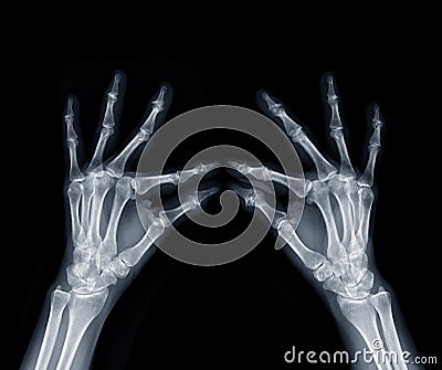 Film x-ray both hand oblique view show human's hands isolated on black background Stock Photo