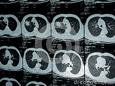 Film x-ray of chest Stock Photo