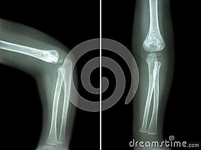 Film x-ray of child's elbow ( normal child's elbow ) ( Side and front view , Lateral and Anterior - Posterior view ) ( 2 positio Stock Photo