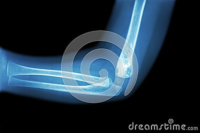 Film x-ray of child's elbow ( normal child's elbow ) ( Side view , Lateral ) Stock Photo