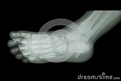 Film x-ray of child's foot ( side view ) ( lateral ) Stock Photo