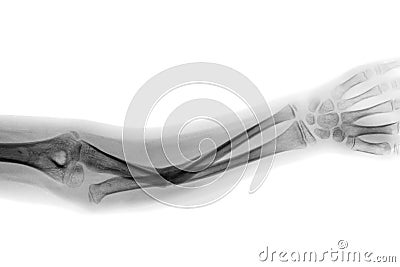 Film x-ray forearm AP show fracture shaft of ulnar bone Stock Photo