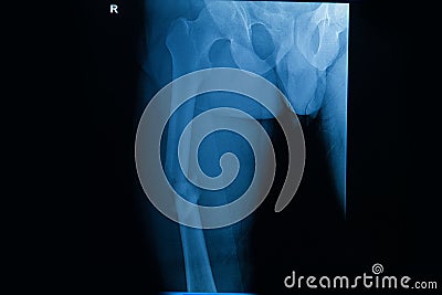 Film x-ray fracture right femur Stock Photo
