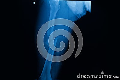 Film x-ray fracture right femur Stock Photo
