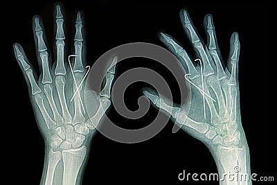 Film x-ray of hand fracture : show fracture metacarpal bone insert with k-wire Stock Photo