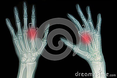 Film x-ray of hand fracture Stock Photo