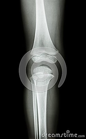 Film x-ray knee AP(antero-posterior) of child Stock Photo