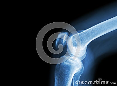 Film x-ray knee joint with arthritis ( Gout , Rheumatoid arthritis , Septic arthritis , Osteoarthritis knee ) and blank area at le Stock Photo