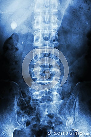 Film x-ray KUB Kidney - ureter - bladder show right renal stone round shape at left side Stock Photo