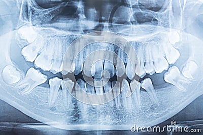 Film x-ray of a mouth. Stock Photo