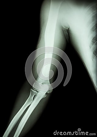 film x-ray of normal arm , elbow and forearm & x28;black background & x29; Stock Photo