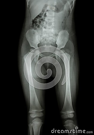 Film x-ray normal body of child (abdomen,buttock,thigh,knee) Stock Photo