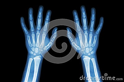 Film X-ray normal both hands of child Stock Photo