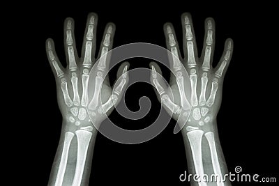 Film X-ray normal both hands of child Stock Photo