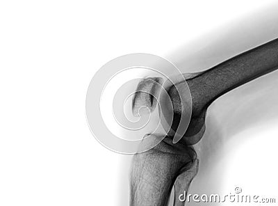 Film x-ray of normal knee joint Stock Photo