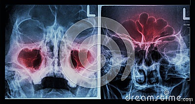 Film X-ray paranasal sinus : show sinusitis at maxillary sinus ( left image ) , frontal sinus ( right image ) Stock Photo