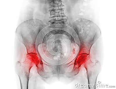 Film x-ray pelvis of osteoporosis patient and arthritis both hip Stock Photo