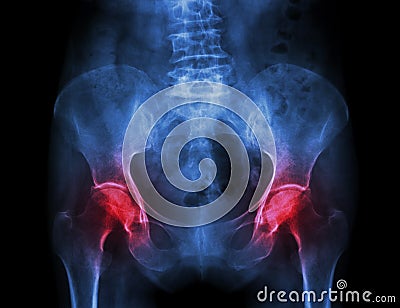 Film x-ray pelvis of osteoporosis patient and arthritis both hip Stock Photo