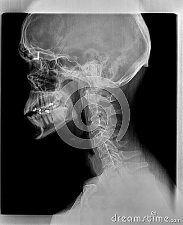 Film x ray or radiograph of a cervical neck. Lateral side view showing straightening or slight kyphosis normally seen after a Stock Photo