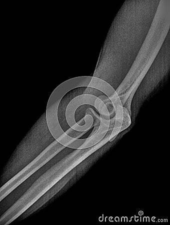 Film x ray or radiograph of a normal adult elbow. Lateral oblique view showing normal bone structure of humerus, radius and ulna Stock Photo