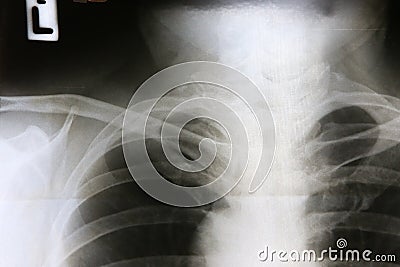 Film x-ray right clavicle Stock Photo