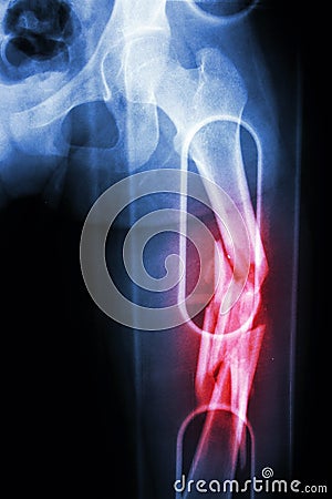 Film X-ray show comminute fracture shaft of femur (thigh bone). It was spliced Stock Photo