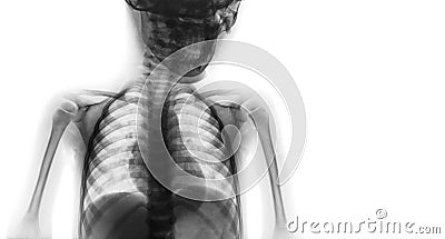 Film x-ray upper half body of child and blank area at right side Stock Photo