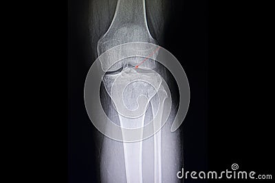Fracture tibial spine film Stock Photo