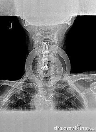 Film xray or radiograph of a cervical neck. AP anterior posterior view showing surgical bracket to help stabilize the patients Stock Photo