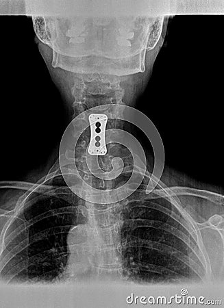 Film xray or radiograph of a cervical neck. AP anterior posterior view showing surgical bracket to help stabilize the patients Stock Photo