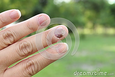 Finger with onychomycosis. A toenail fungus.. - soft focus Stock Photo