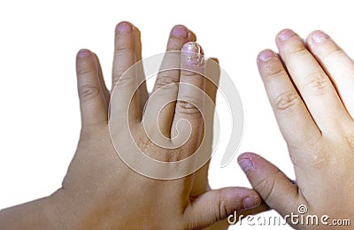 finger swollen with inflammation due to Nail ripped infection Stock Photo