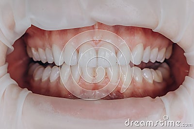 Finished ceramic front crowns. 8 units dental veneers. Stock Photo