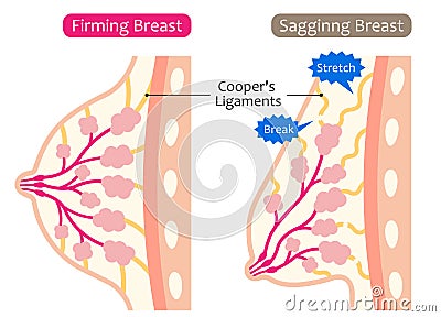 Firm and sagging breasts illustration. womenâ€™s beauty body care concept Vector Illustration