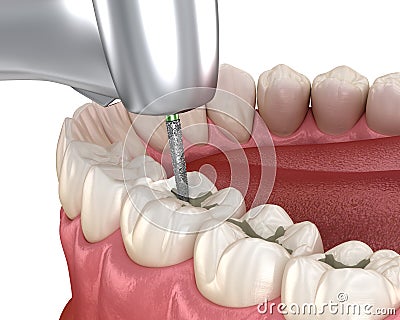 Fissure Preparation for fillings placement, Medically accurate 3D illustration of dental concept Cartoon Illustration