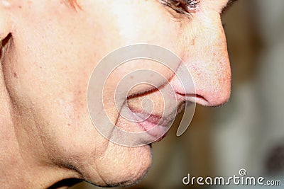 Flabbiness of the skin of the cheeks. Wrinkles on the face. Nasolabial wrinkles. Stock Photo