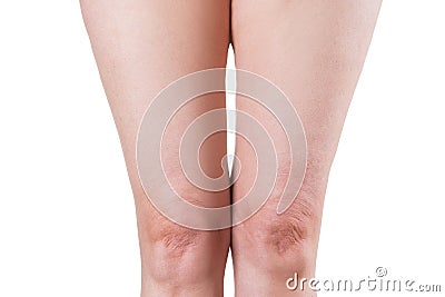 Flabby skin on female legs, older woman`s knees isolated on white background Stock Photo