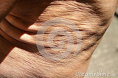 Flabby skin. Skin fold on the abdomen and chest Stock Photo