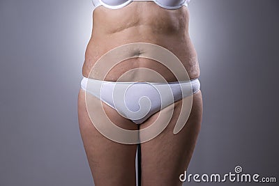 Flabby woman`s belly with stretch marks Stock Photo