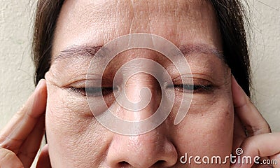 The Flabby wrinkles and ptosis beside the eyelid Stock Photo